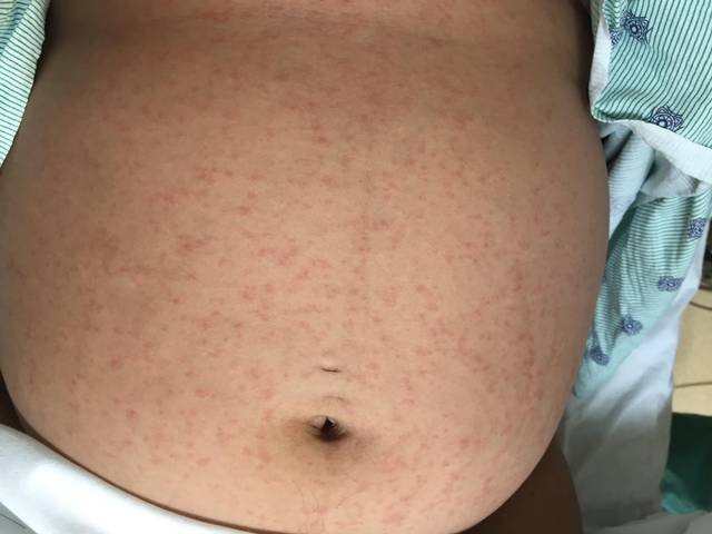 Skin Rash on First Pregnant Woman with Zika in Miami